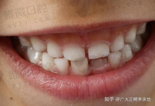 牙套的种类详解（牙套的类型）(图1)